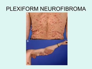 PLEXIFORM NEUROFIBROMA
 