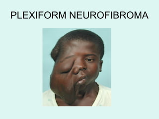 PLEXIFORM NEUROFIBROMA
 