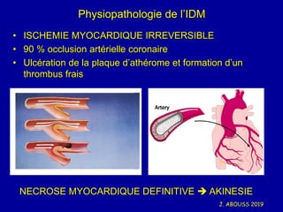 J. ABOUSS 2019
Physiopathologie de l’IDM
• ISCHEMIE MYOCARDIQUE IRREVERSIBLE
• 90 % occlusion artérielle coronaire
• Ulcér...