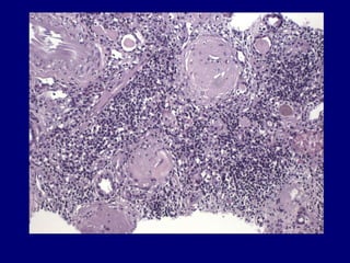 22 kim acute interstitial nephritis | PPT