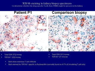 22 kim acute interstitial nephritis | PPT