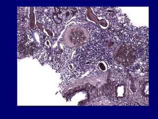 22 kim acute interstitial nephritis | PPT