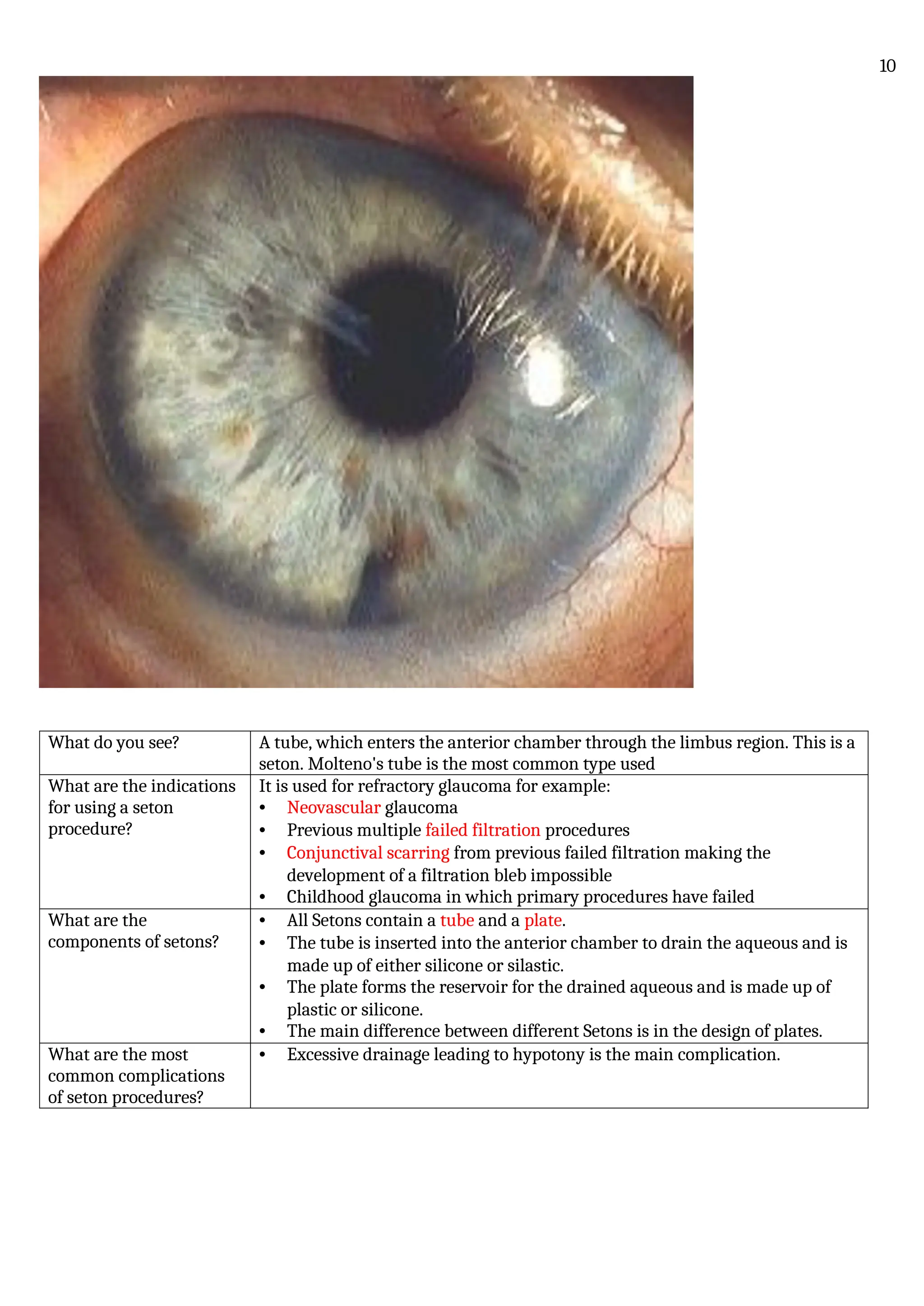 What do you see? A tube, which enters the anterior chamber through the limbus region. This is a
seton. Molteno's tube is the most common type used
What are the indications
for using a seton
procedure?
It is used for refractory glaucoma for example:
• Neovascular glaucoma
• Previous multiple failed filtration procedures
• Conjunctival scarring from previous failed filtration making the
development of a filtration bleb impossible
• Childhood glaucoma in which primary procedures have failed
What are the
components of setons?
• All Setons contain a tube and a plate.
• The tube is inserted into the anterior chamber to drain the aqueous and is
made up of either silicone or silastic.
• The plate forms the reservoir for the drained aqueous and is made up of
plastic or silicone.
• The main difference between different Setons is in the design of plates.
What are the most
common complications
of seton procedures?
• Excessive drainage leading to hypotony is the main complication.
10
 