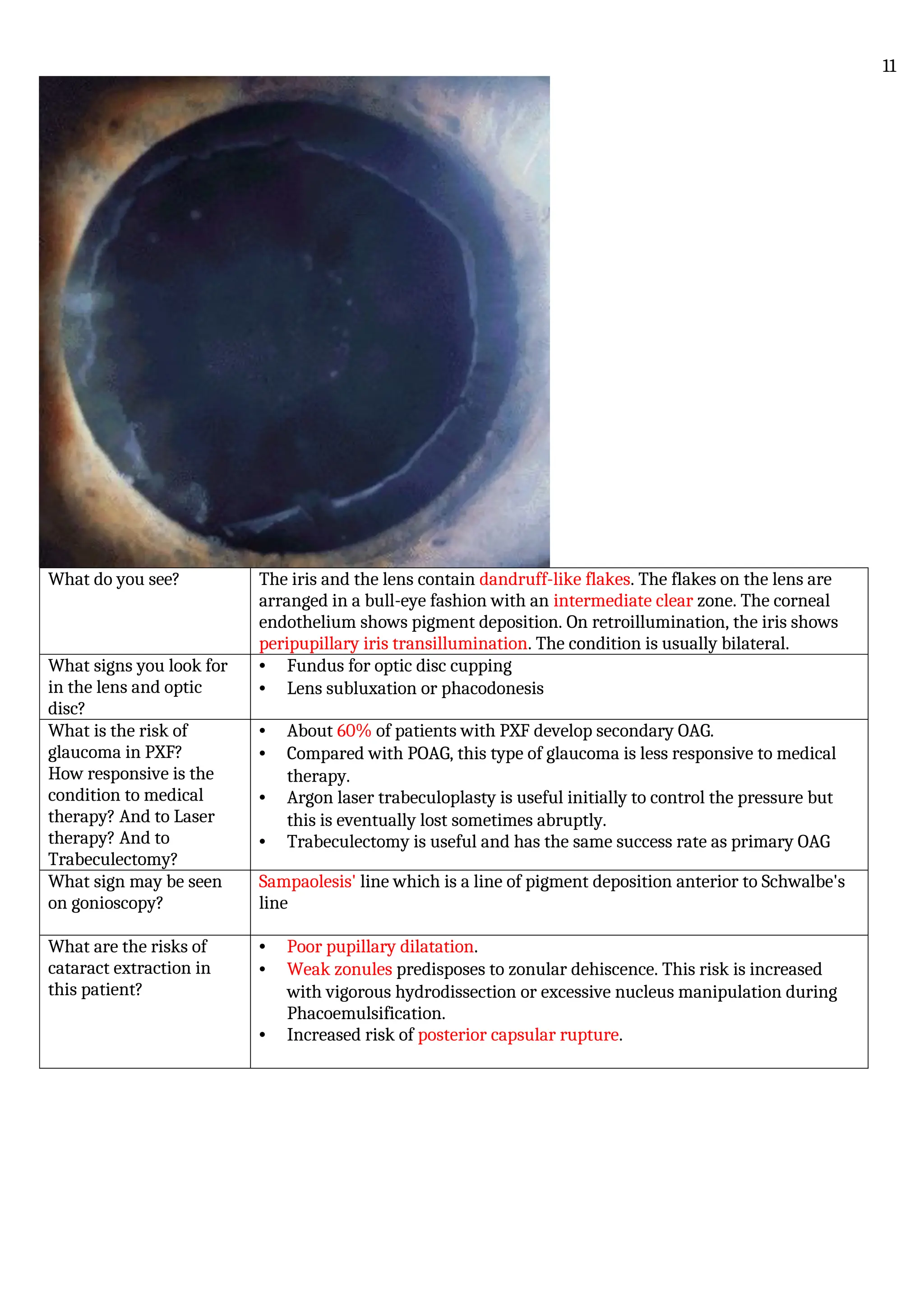 What do you see? The iris and the lens contain dandruff-like flakes. The flakes on the lens are
arranged in a bull-eye fashion with an intermediate clear zone. The corneal
endothelium shows pigment deposition. On retroillumination, the iris shows
peripupillary iris transillumination. The condition is usually bilateral.
What signs you look for
in the lens and optic
disc?
• Fundus for optic disc cupping
• Lens subluxation or phacodonesis
What is the risk of
glaucoma in PXF?
How responsive is the
condition to medical
therapy? And to Laser
therapy? And to
Trabeculectomy?
• About 60% of patients with PXF develop secondary OAG.
• Compared with POAG, this type of glaucoma is less responsive to medical
therapy.
• Argon laser trabeculoplasty is useful initially to control the pressure but
this is eventually lost sometimes abruptly.
• Trabeculectomy is useful and has the same success rate as primary OAG
What sign may be seen
on gonioscopy?
Sampaolesis' line which is a line of pigment deposition anterior to Schwalbe's
line
What are the risks of
cataract extraction in
this patient?
• Poor pupillary dilatation.
• Weak zonules predisposes to zonular dehiscence. This risk is increased
with vigorous hydrodissection or excessive nucleus manipulation during
Phacoemulsification.
• Increased risk of posterior capsular rupture.
11
 