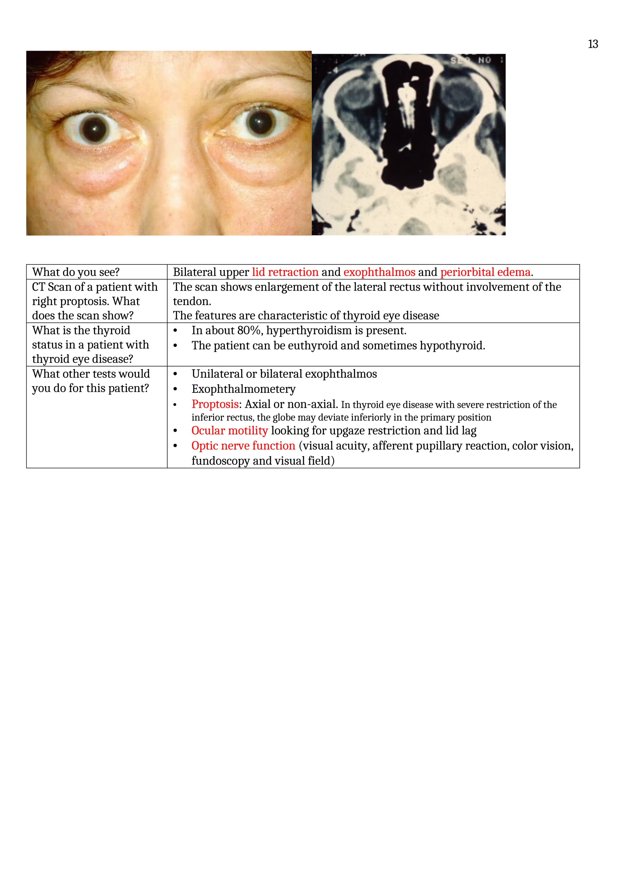 What do you see? Bilateral upper lid retraction and exophthalmos and periorbital edema.
CT Scan of a patient with
right proptosis. What
does the scan show?
The scan shows enlargement of the lateral rectus without involvement of the
tendon.
The features are characteristic of thyroid eye disease
What is the thyroid
status in a patient with
thyroid eye disease?
• In about 80%, hyperthyroidism is present.
• The patient can be euthyroid and sometimes hypothyroid.
What other tests would
you do for this patient?
• Unilateral or bilateral exophthalmos
• Exophthalmometery
• Proptosis: Axial or non-axial. In thyroid eye disease with severe restriction of the
inferior rectus, the globe may deviate inferiorly in the primary position
• Ocular motility looking for upgaze restriction and lid lag
• Optic nerve function (visual acuity, afferent pupillary reaction, color vision,
fundoscopy and visual field)
13
 
