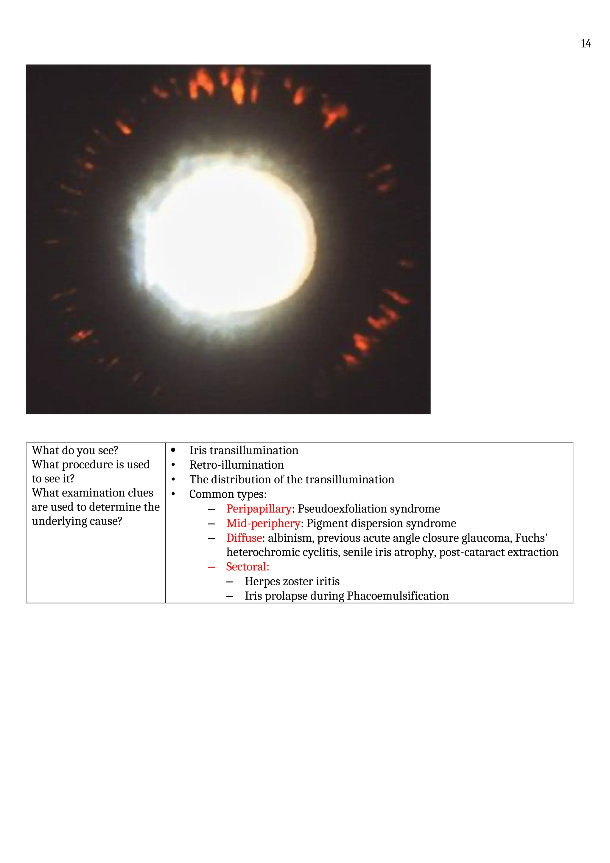What do you see?
What procedure is used
to see it?
What examination clues
are used to determine the
underlying cause?
 Iris transillumination
• Retro-illumination
• The distribution of the transillumination
• Common types:
– Peripapillary: Pseudoexfoliation syndrome
– Mid-periphery: Pigment dispersion syndrome
– Diffuse: albinism, previous acute angle closure glaucoma, Fuchs'
heterochromic cyclitis, senile iris atrophy, post-cataract extraction
– Sectoral:
– Herpes zoster iritis
– Iris prolapse during Phacoemulsification
14
 