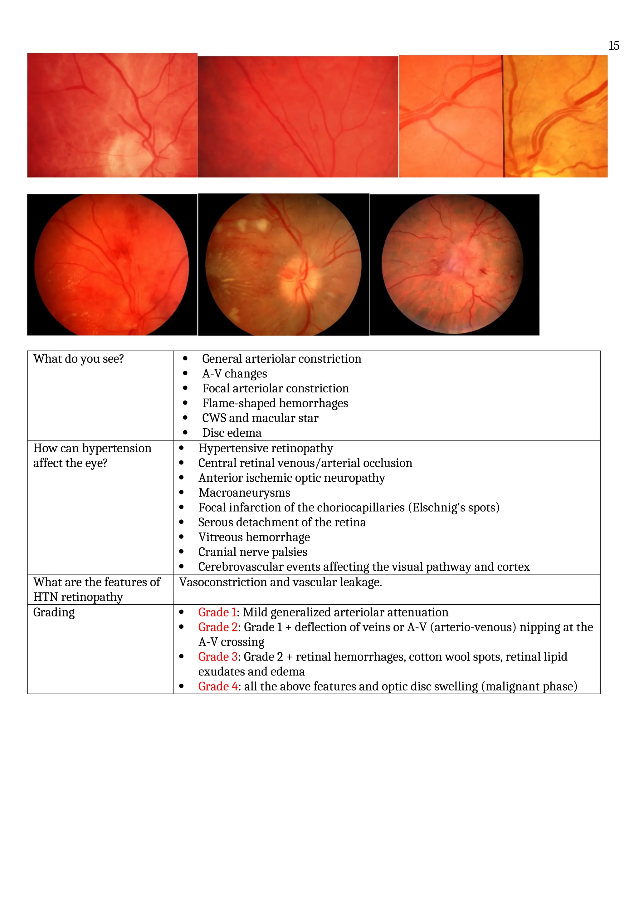 What do you see?  General arteriolar constriction
 A-V changes
 Focal arteriolar constriction
 Flame-shaped hemorrhages
 CWS and macular star
 Disc edema
How can hypertension
affect the eye?
 Hypertensive retinopathy
 Central retinal venous/arterial occlusion
 Anterior ischemic optic neuropathy
 Macroaneurysms
 Focal infarction of the choriocapillaries (Elschnig's spots)
 Serous detachment of the retina
 Vitreous hemorrhage
 Cranial nerve palsies
 Cerebrovascular events affecting the visual pathway and cortex
What are the features of
HTN retinopathy
Vasoconstriction and vascular leakage.
Grading  Grade 1: Mild generalized arteriolar attenuation
 Grade 2: Grade 1 + deflection of veins or A-V (arterio-venous) nipping at the
A-V crossing
 Grade 3: Grade 2 + retinal hemorrhages, cotton wool spots, retinal lipid
exudates and edema
 Grade 4: all the above features and optic disc swelling (malignant phase)
15
 