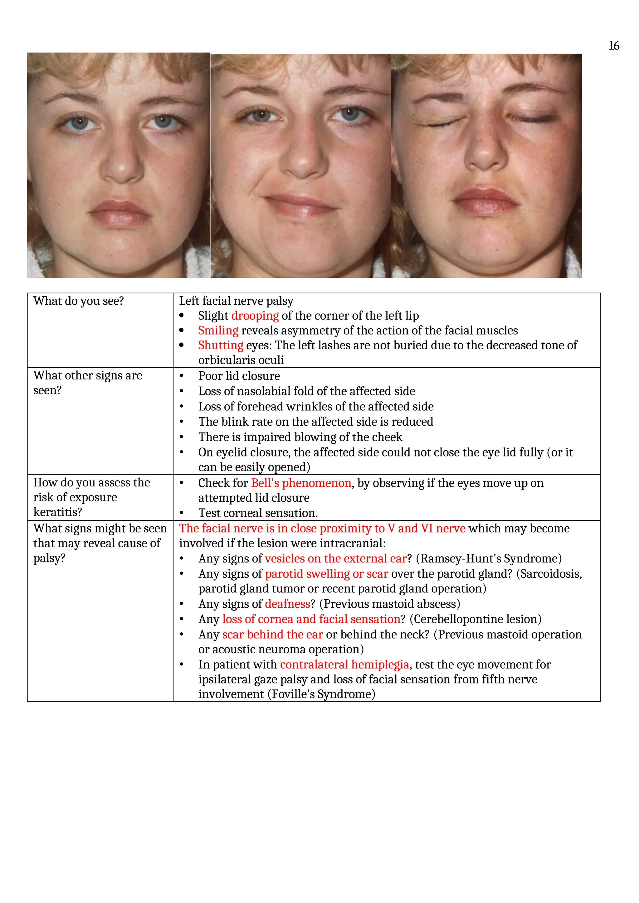 What do you see? Left facial nerve palsy
 Slight drooping of the corner of the left lip
 Smiling reveals asymmetry of the action of the facial muscles
 Shutting eyes: The left lashes are not buried due to the decreased tone of
orbicularis oculi
What other signs are
seen?
• Poor lid closure
• Loss of nasolabial fold of the affected side
• Loss of forehead wrinkles of the affected side
• The blink rate on the affected side is reduced
• There is impaired blowing of the cheek
• On eyelid closure, the affected side could not close the eye lid fully (or it
can be easily opened)
How do you assess the
risk of exposure
keratitis?
• Check for Bell's phenomenon, by observing if the eyes move up on
attempted lid closure
• Test corneal sensation.
What signs might be seen
that may reveal cause of
palsy?
The facial nerve is in close proximity to V and VI nerve which may become
involved if the lesion were intracranial:
• Any signs of vesicles on the external ear? (Ramsey-Hunt's Syndrome)
• Any signs of parotid swelling or scar over the parotid gland? (Sarcoidosis,
parotid gland tumor or recent parotid gland operation)
• Any signs of deafness? (Previous mastoid abscess)
• Any loss of cornea and facial sensation? (Cerebellopontine lesion)
• Any scar behind the ear or behind the neck? (Previous mastoid operation
or acoustic neuroma operation)
• In patient with contralateral hemiplegia, test the eye movement for
ipsilateral gaze palsy and loss of facial sensation from fifth nerve
involvement (Foville's Syndrome)
16
 