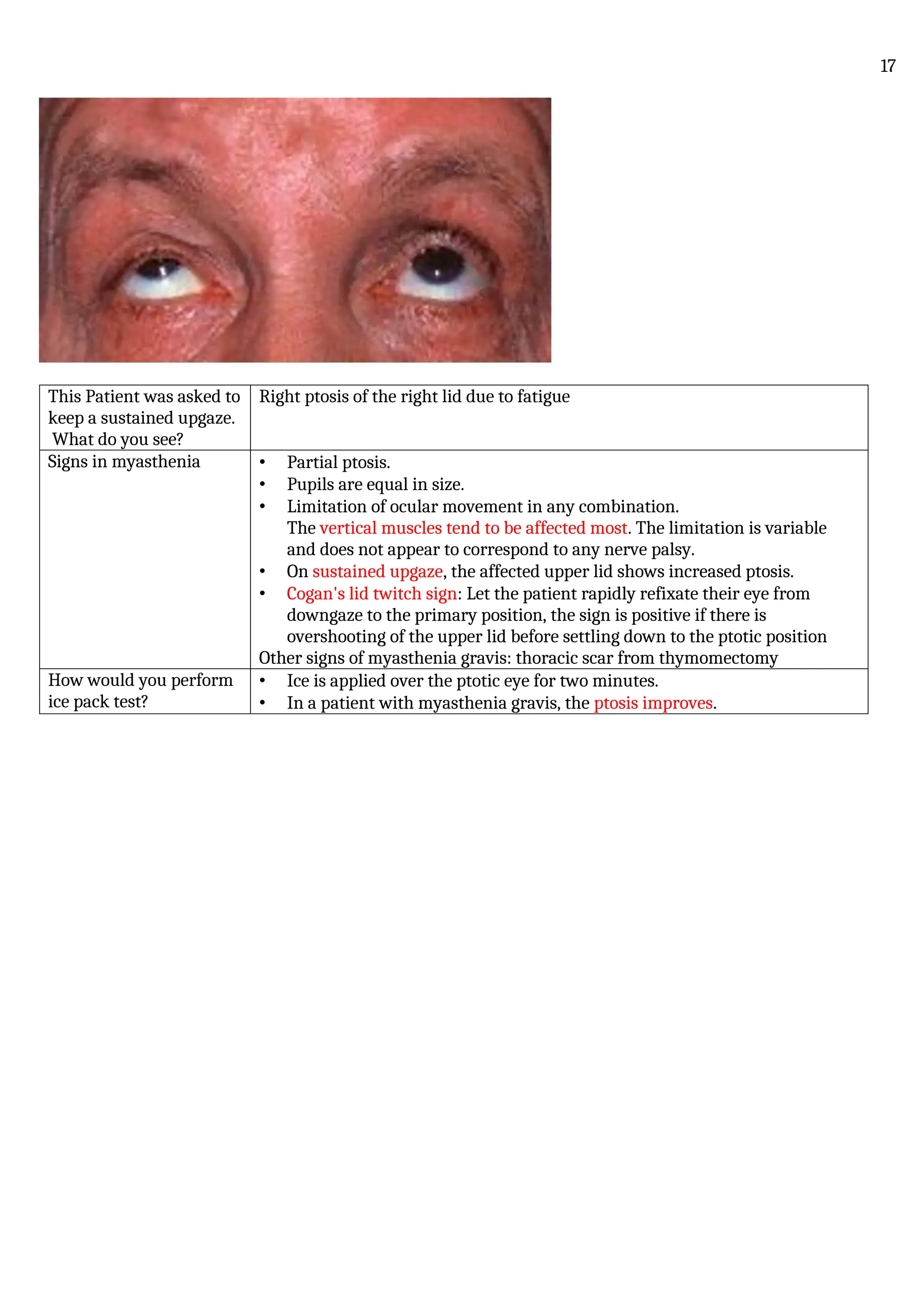 This Patient was asked to
keep a sustained upgaze.
What do you see?
Right ptosis of the right lid due to fatigue
Signs in myasthenia • Partial ptosis.
• Pupils are equal in size.
• Limitation of ocular movement in any combination.
The vertical muscles tend to be affected most. The limitation is variable
and does not appear to correspond to any nerve palsy.
• On sustained upgaze, the affected upper lid shows increased ptosis.
• Cogan's lid twitch sign: Let the patient rapidly refixate their eye from
downgaze to the primary position, the sign is positive if there is
overshooting of the upper lid before settling down to the ptotic position
Other signs of myasthenia gravis: thoracic scar from thymomectomy
How would you perform
ice pack test?
• Ice is applied over the ptotic eye for two minutes.
• In a patient with myasthenia gravis, the ptosis improves.
17
 
