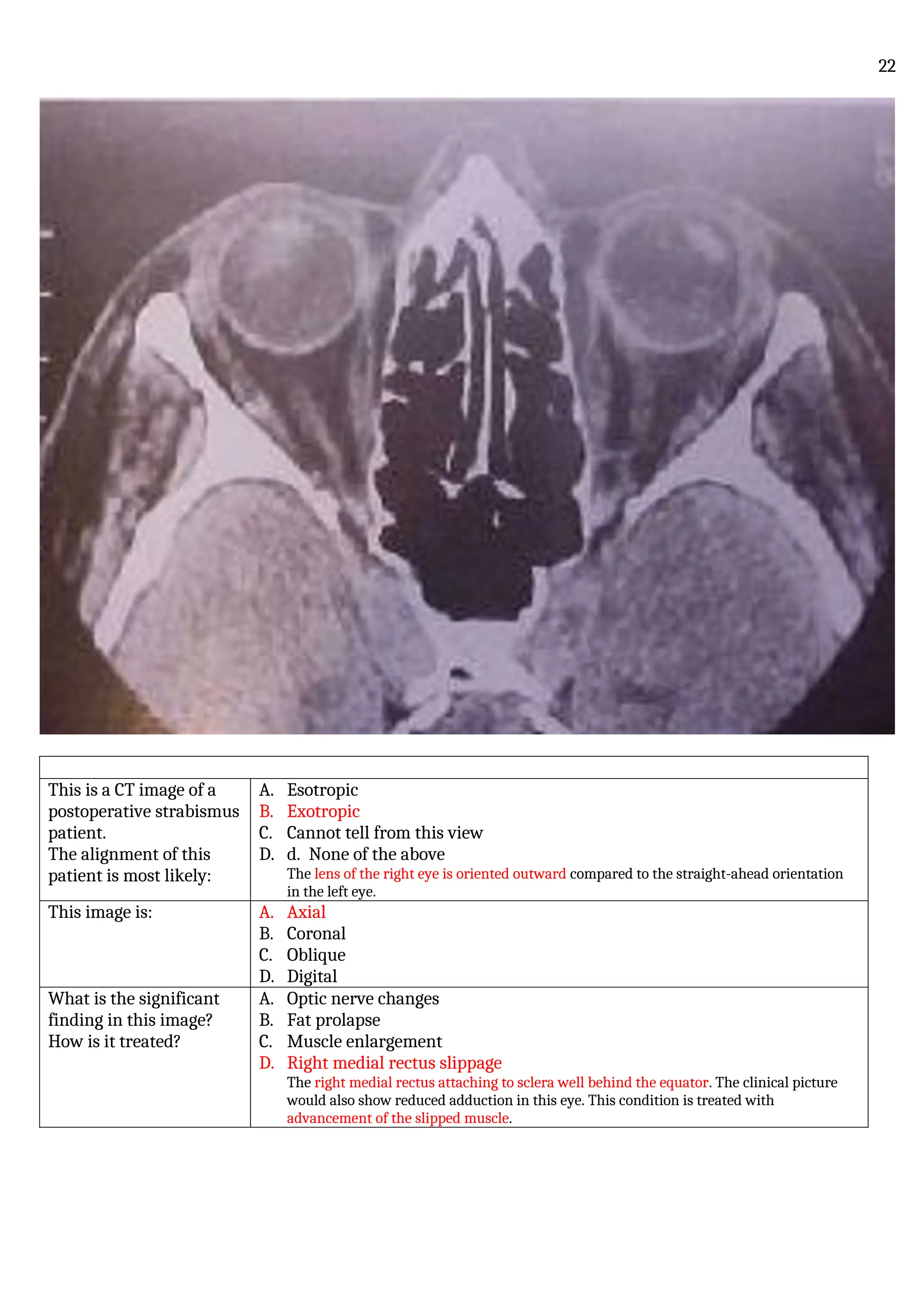 This is a CT image of a
postoperative strabismus
patient.
The alignment of this
patient is most likely:
A. Esotropic
B. Exotropic
C. Cannot tell from this view
D. d. None of the above
The lens of the right eye is oriented outward compared to the straight-ahead orientation
in the left eye.
This image is: A. Axial
B. Coronal
C. Oblique
D. Digital
What is the significant
finding in this image?
How is it treated?
A. Optic nerve changes
B. Fat prolapse
C. Muscle enlargement
D. Right medial rectus slippage
The right medial rectus attaching to sclera well behind the equator. The clinical picture
would also show reduced adduction in this eye. This condition is treated with
advancement of the slipped muscle.
22
 
