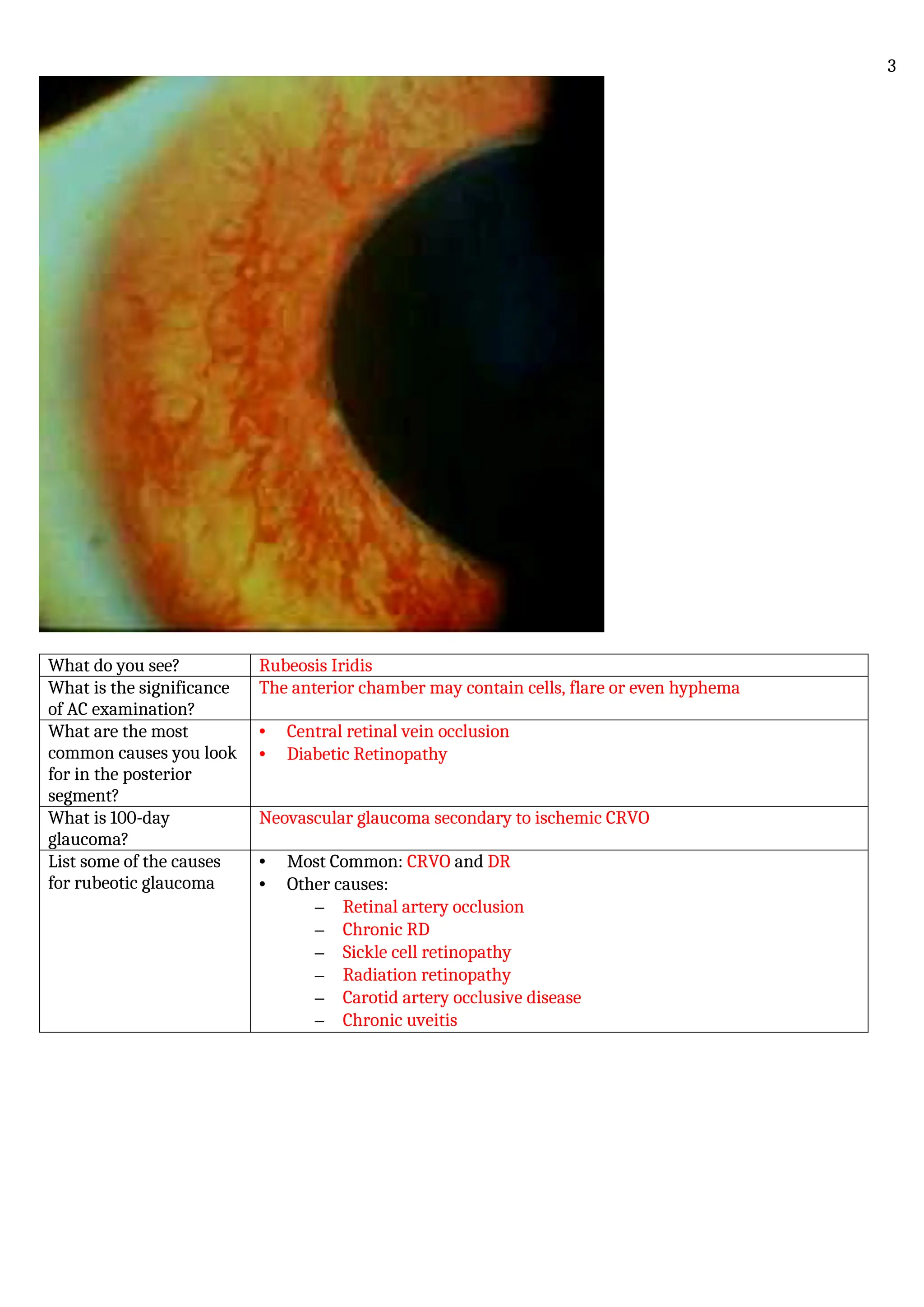 What do you see? Rubeosis Iridis
What is the significance
of AC examination?
The anterior chamber may contain cells, flare or even hyphema
What are the most
common causes you look
for in the posterior
segment?
• Central retinal vein occlusion
• Diabetic Retinopathy
What is 100-day
glaucoma?
Neovascular glaucoma secondary to ischemic CRVO
List some of the causes
for rubeotic glaucoma
• Most Common: CRVO and DR
• Other causes:
– Retinal artery occlusion
– Chronic RD
– Sickle cell retinopathy
– Radiation retinopathy
– Carotid artery occlusive disease
– Chronic uveitis
3
 