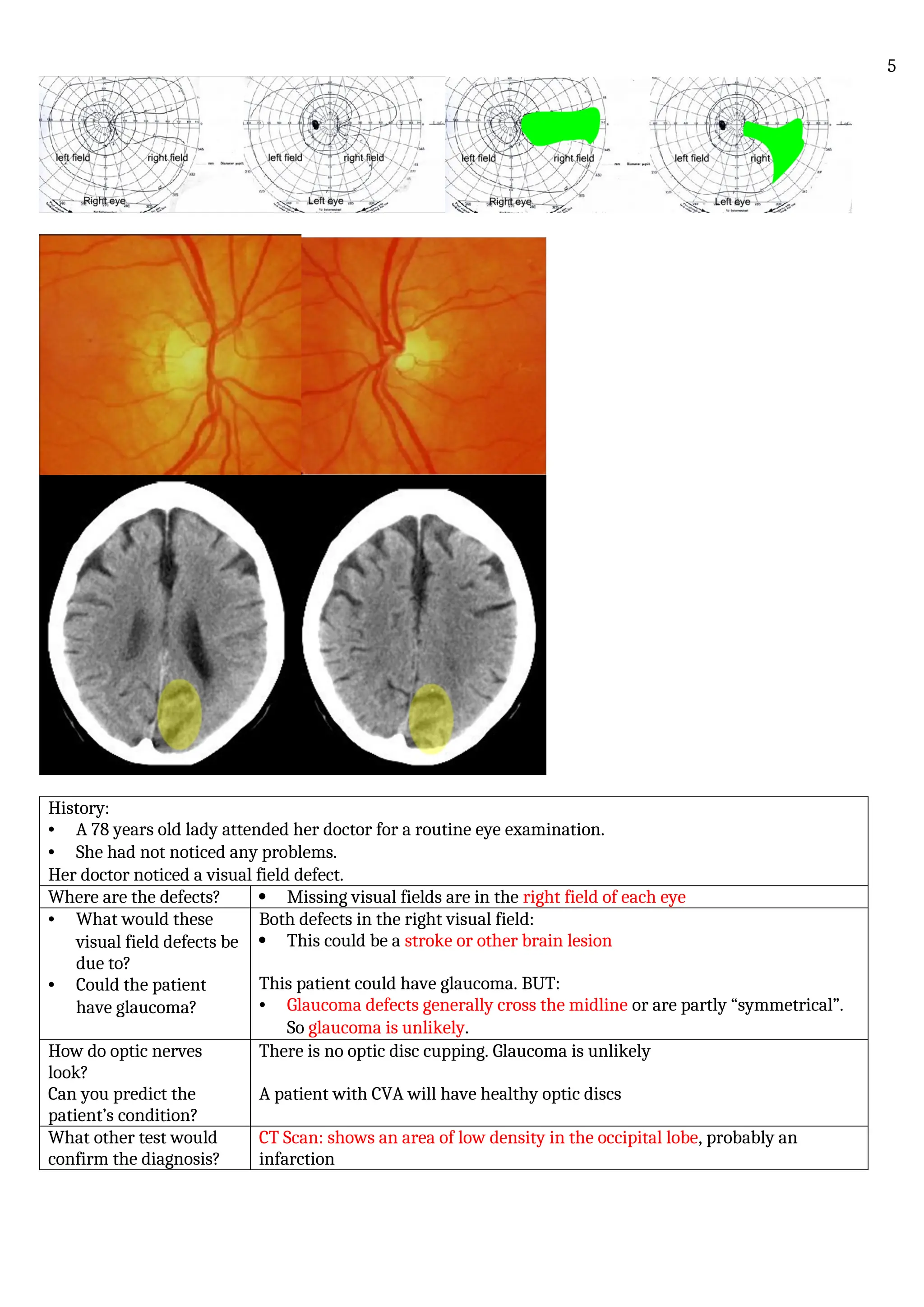 History:
• A 78 years old lady attended her doctor for a routine eye examination.
• She had not noticed any problems.
Her doctor noticed a visual field defect.
Where are the defects?  Missing visual fields are in the right field of each eye
• What would these
visual field defects be
due to?
• Could the patient
have glaucoma?
Both defects in the right visual field:
 This could be a stroke or other brain lesion
This patient could have glaucoma. BUT:
• Glaucoma defects generally cross the midline or are partly “symmetrical”.
So glaucoma is unlikely.
How do optic nerves
look?
Can you predict the
patient’s condition?
There is no optic disc cupping. Glaucoma is unlikely
A patient with CVA will have healthy optic discs
What other test would
confirm the diagnosis?
CT Scan: shows an area of low density in the occipital lobe, probably an
infarction
5
 