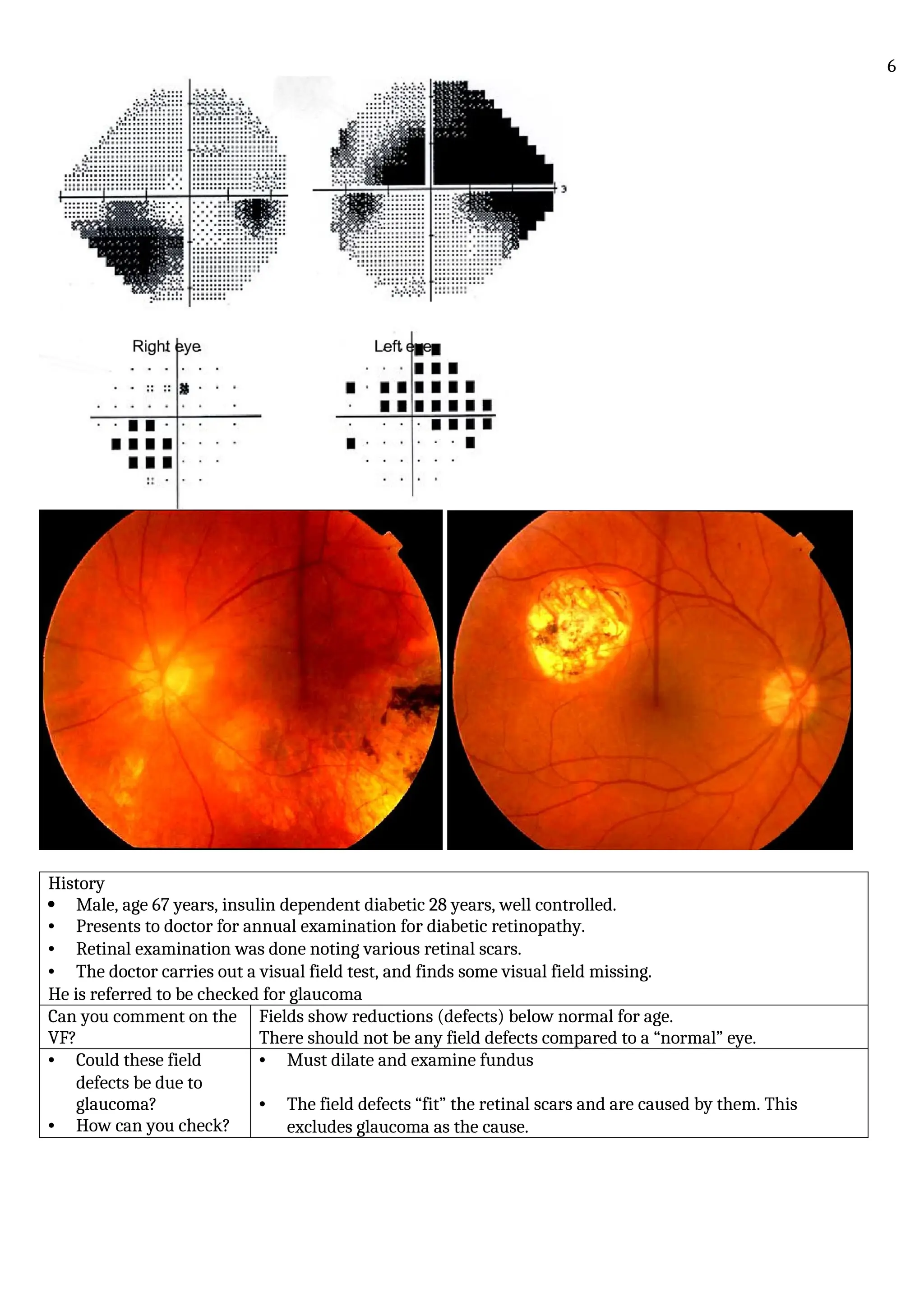 History
 Male, age 67 years, insulin dependent diabetic 28 years, well controlled.
• Presents to doctor for annual examination for diabetic retinopathy.
• Retinal examination was done noting various retinal scars.
• The doctor carries out a visual field test, and finds some visual field missing.
He is referred to be checked for glaucoma
Can you comment on the
VF?
Fields show reductions (defects) below normal for age.
There should not be any field defects compared to a “normal” eye.
• Could these field
defects be due to
glaucoma?
• How can you check?
• Must dilate and examine fundus
• The field defects “fit” the retinal scars and are caused by them. This
excludes glaucoma as the cause.
6
 
