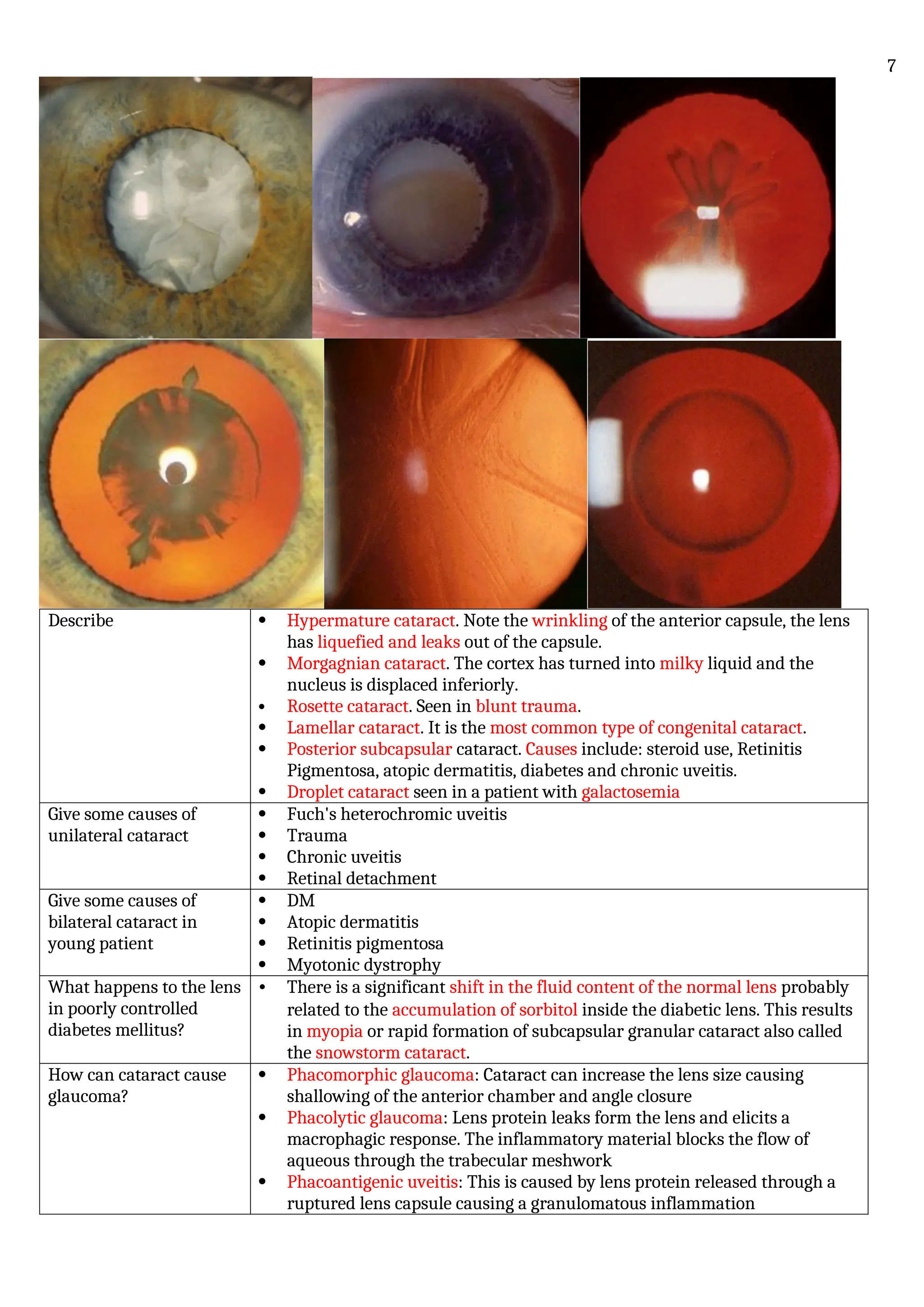 Describe  Hypermature cataract. Note the wrinkling of the anterior capsule, the lens
has liquefied and leaks out of the capsule.
 Morgagnian cataract. The cortex has turned into milky liquid and the
nucleus is displaced inferiorly.
 Rosette cataract. Seen in blunt trauma.
 Lamellar cataract. It is the most common type of congenital cataract.
 Posterior subcapsular cataract. Causes include: steroid use, Retinitis
Pigmentosa, atopic dermatitis, diabetes and chronic uveitis.
 Droplet cataract seen in a patient with galactosemia
Give some causes of
unilateral cataract
 Fuch's heterochromic uveitis
 Trauma
 Chronic uveitis
 Retinal detachment
Give some causes of
bilateral cataract in
young patient
 DM
 Atopic dermatitis
 Retinitis pigmentosa
 Myotonic dystrophy
What happens to the lens
in poorly controlled
diabetes mellitus?
• There is a significant shift in the fluid content of the normal lens probably
related to the accumulation of sorbitol inside the diabetic lens. This results
in myopia or rapid formation of subcapsular granular cataract also called
the snowstorm cataract.
How can cataract cause
glaucoma?
 Phacomorphic glaucoma: Cataract can increase the lens size causing
shallowing of the anterior chamber and angle closure
 Phacolytic glaucoma: Lens protein leaks form the lens and elicits a
macrophagic response. The inflammatory material blocks the flow of
aqueous through the trabecular meshwork
 Phacoantigenic uveitis: This is caused by lens protein released through a
ruptured lens capsule causing a granulomatous inflammation
7
 