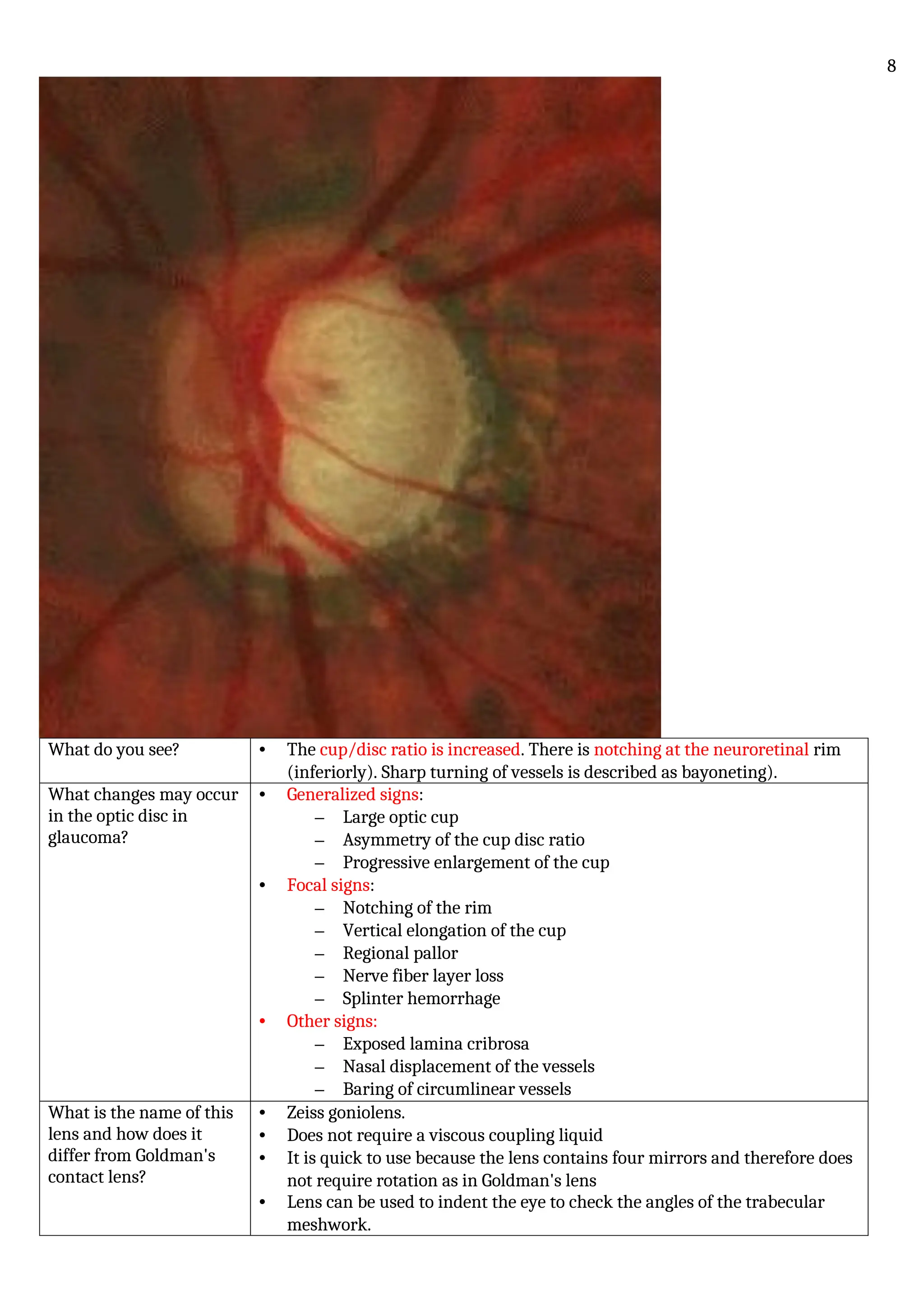 What do you see? • The cup/disc ratio is increased. There is notching at the neuroretinal rim
(inferiorly). Sharp turning of vessels is described as bayoneting).
What changes may occur
in the optic disc in
glaucoma?
• Generalized signs:
– Large optic cup
– Asymmetry of the cup disc ratio
– Progressive enlargement of the cup
• Focal signs:
– Notching of the rim
– Vertical elongation of the cup
– Regional pallor
– Nerve fiber layer loss
– Splinter hemorrhage
• Other signs:
– Exposed lamina cribrosa
– Nasal displacement of the vessels
– Baring of circumlinear vessels
What is the name of this
lens and how does it
differ from Goldman's
contact lens?
• Zeiss goniolens.
• Does not require a viscous coupling liquid
• It is quick to use because the lens contains four mirrors and therefore does
not require rotation as in Goldman's lens
• Lens can be used to indent the eye to check the angles of the trabecular
meshwork.
8
 
