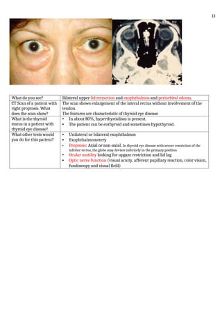 What do you see? Bilateral upper lid retraction and exophthalmos and periorbital edema.
CT Scan of a patient with
right proptosis. What
does the scan show?
The scan shows enlargement of the lateral rectus without involvement of the
tendon.
The features are characteristic of thyroid eye disease
What is the thyroid
status in a patient with
thyroid eye disease?
• In about 80%, hyperthyroidism is present.
• The patient can be euthyroid and sometimes hypothyroid.
What other tests would
you do for this patient?
• Unilateral or bilateral exophthalmos
• Exophthalmometery
• Proptosis: Axial or non-axial. In thyroid eye disease with severe restriction of the
inferior rectus, the globe may deviate inferiorly in the primary position
• Ocular motility looking for upgaze restriction and lid lag
• Optic nerve function (visual acuity, afferent pupillary reaction, color vision,
fundoscopy and visual field)
13
 