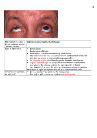 This Patient was asked to
keep a sustained upgaze.
What do you see?
Right ptosis of the right lid due to fatigue
Signs in myasthenia • Partial ptosis.
• Pupils are equal in size.
• Limitation of ocular movement in any combination.
The vertical muscles tend to be affected most. The limitation is variable
and does not appear to correspond to any nerve palsy.
• On sustained upgaze, the affected upper lid shows increased ptosis.
• Cogan's lid twitch sign: Let the patient rapidly refixate their eye from
downgaze to the primary position, the sign is positive if there is
overshooting of the upper lid before settling down to the ptotic position
Other signs of myasthenia gravis: thoracic scar from thymomectomy
How would you perform
ice pack test?
• Ice is applied over the ptotic eye for two minutes.
• In a patient with myasthenia gravis, the ptosis improves.
17
 