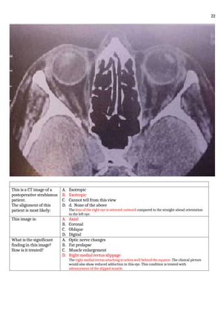 This is a CT image of a
postoperative strabismus
patient.
The alignment of this
patient is most likely:
A. Esotropic
B. Exotropic
C. Cannot tell from this view
D. d. None of the above
The lens of the right eye is oriented outward compared to the straight-ahead orientation
in the left eye.
This image is: A. Axial
B. Coronal
C. Oblique
D. Digital
What is the significant
finding in this image?
How is it treated?
A. Optic nerve changes
B. Fat prolapse
C. Muscle enlargement
D. Right medial rectus slippage
The right medial rectus attaching to sclera well behind the equator. The clinical picture
would also show reduced adduction in this eye. This condition is treated with
advancement of the slipped muscle.
22
 