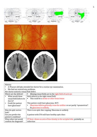 History:
• A 78 years old lady attended her doctor for a routine eye examination.
• She had not noticed any problems.
Her doctor noticed a visual field defect.
Where are the defects?  Missing visual fields are in the right field of each eye
• What would these
visual field defects be
due to?
• Could the patient
have glaucoma?
Both defects in the right visual field:
 This could be a stroke or other brain lesion
This patient could have glaucoma. BUT:
• Glaucoma defects generally cross the midline or are partly “symmetrical”.
So glaucoma is unlikely.
How do optic nerves
look?
Can you predict the
patient’s condition?
There is no optic disc cupping. Glaucoma is unlikely
A patient with CVA will have healthy optic discs
What other test would
confirm the diagnosis?
CT Scan: shows an area of low density in the occipital lobe, probably an
infarction
5
 