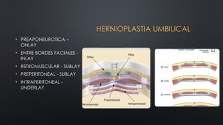 Sublay Retrorectus 22 PARED ABDOMINAL - HERNIAS michans.pptx