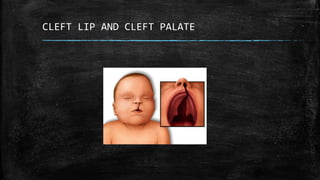 CLEFT LIP AND CLEFT PALATE
 