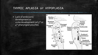 THYMIC APLASIA or HYPOPLASIA
▪ Lack of embryonic
development or
underdevelopment od 3rd or
4th pharyngeal pouches
 