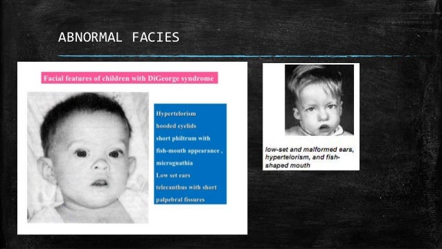 digeorge syndrome