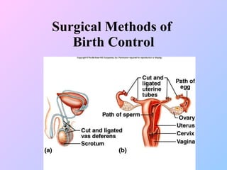 Surgical Methods of  Birth Control 