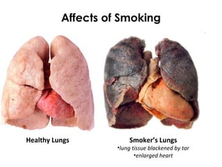 Affects of Smoking
Smoker’s Lungs
•lung tissue blackened by tar
•enlarged heart
Healthy Lungs
 