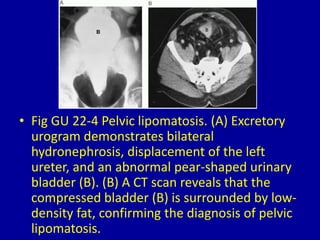22 small urinary bladder | PPTX