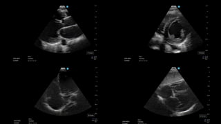 Reviving the Physical Exam: The POCUS Volume Assessment | PDF