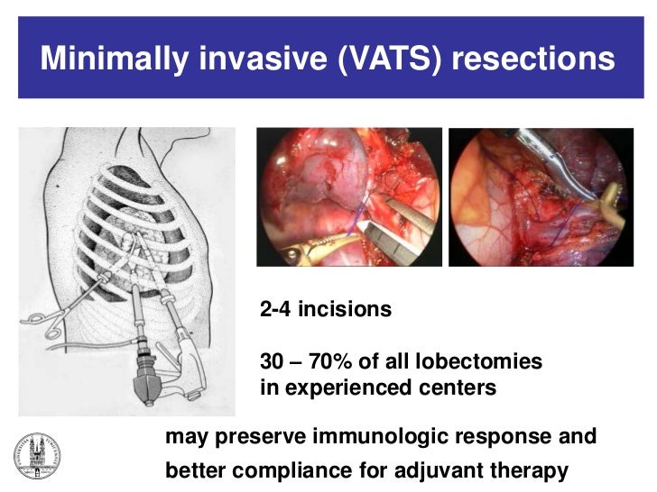 MON 2011 Slide 22 W. Weder Surgery