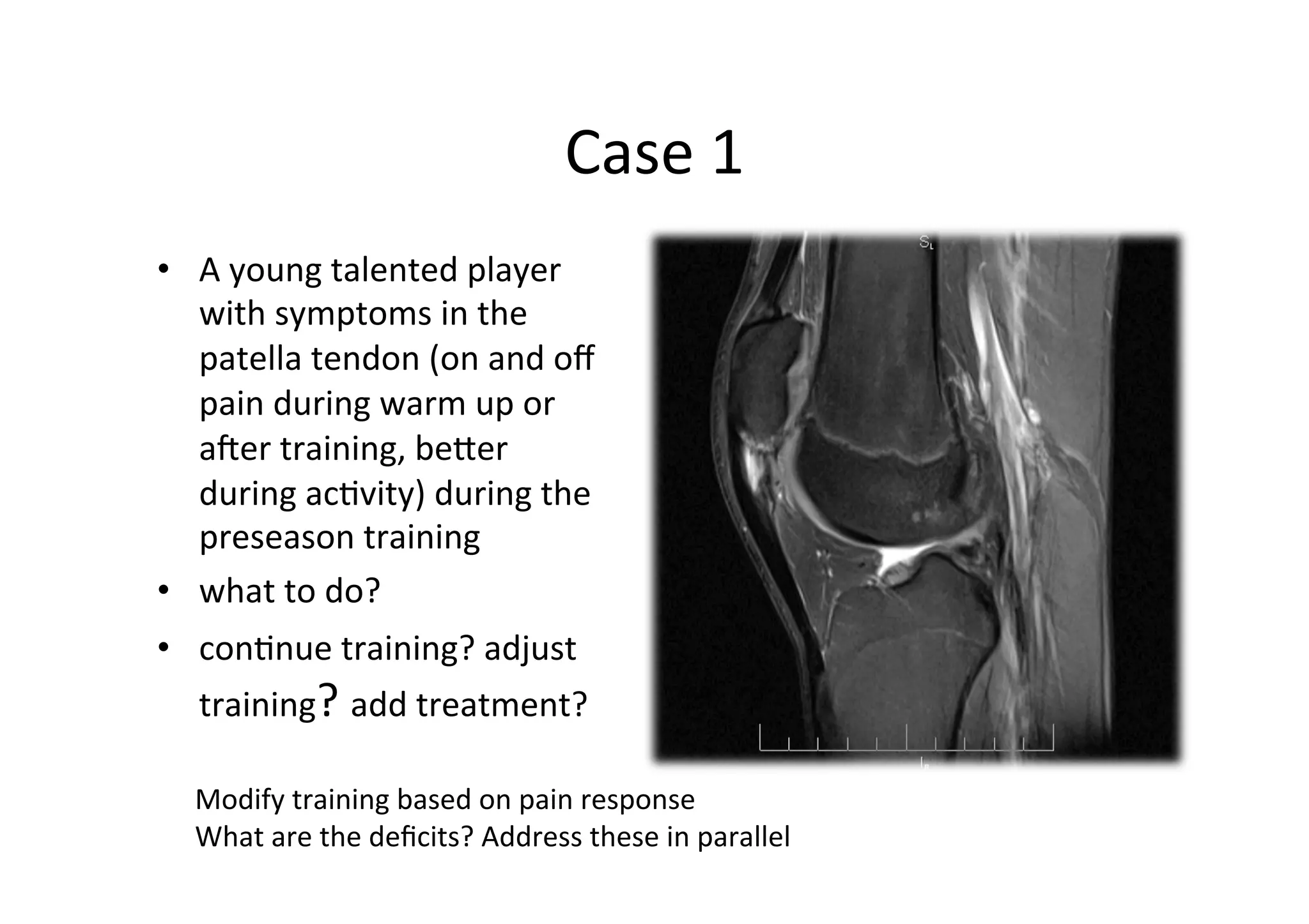 Case	
  1	
  
•  A	
  young	
  talented	
  player	
  
with	
  symptoms	
  in	
  the	
  
patella	
  tendon	
  (on	
  and	
  oﬀ	
  
pain	
  during	
  warm	
  up	
  or	
  
aier	
  training,	
  beper	
  
during	
  ac;vity)	
  during	
  the	
  
preseason	
  training	
  	
  
•  what	
  to	
  do?	
  
•  con;nue	
  training?	
  adjust	
  

training?	
  add	
  treatment?	
  	
  

Modify	
  training	
  based	
  on	
  pain	
  response	
  
What	
  are	
  the	
  deﬁcits?	
  Address	
  these	
  in	
  parallel	
  

 