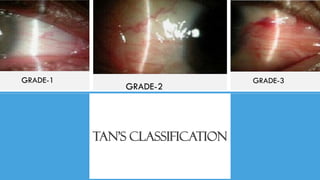 Pterygium (Arma) | PDF