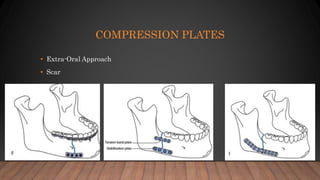 Mandibular and Maxillary Fractures | PPTX
