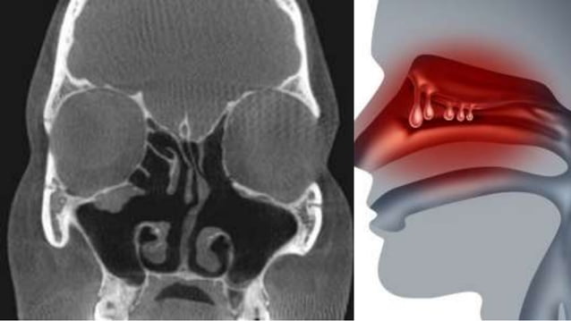 Radiographic Features of Paranasal Sinuses | PPTX | Ear, Nose and ...