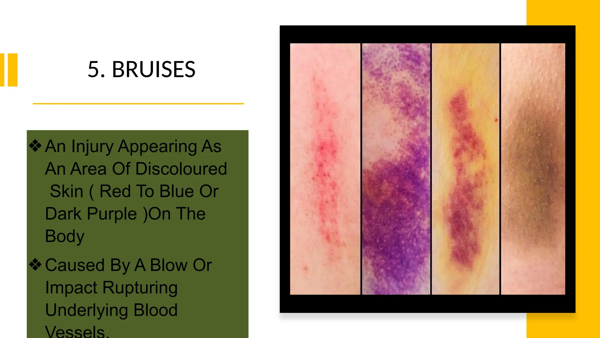 5. BRUISES
❖An Injury Appearing As
An Area Of Discoloured
Skin ( Red To Blue Or
Dark Purple )On The
Body
❖Caused By A Blow Or
Impact Rupturing
Underlying Blood
 