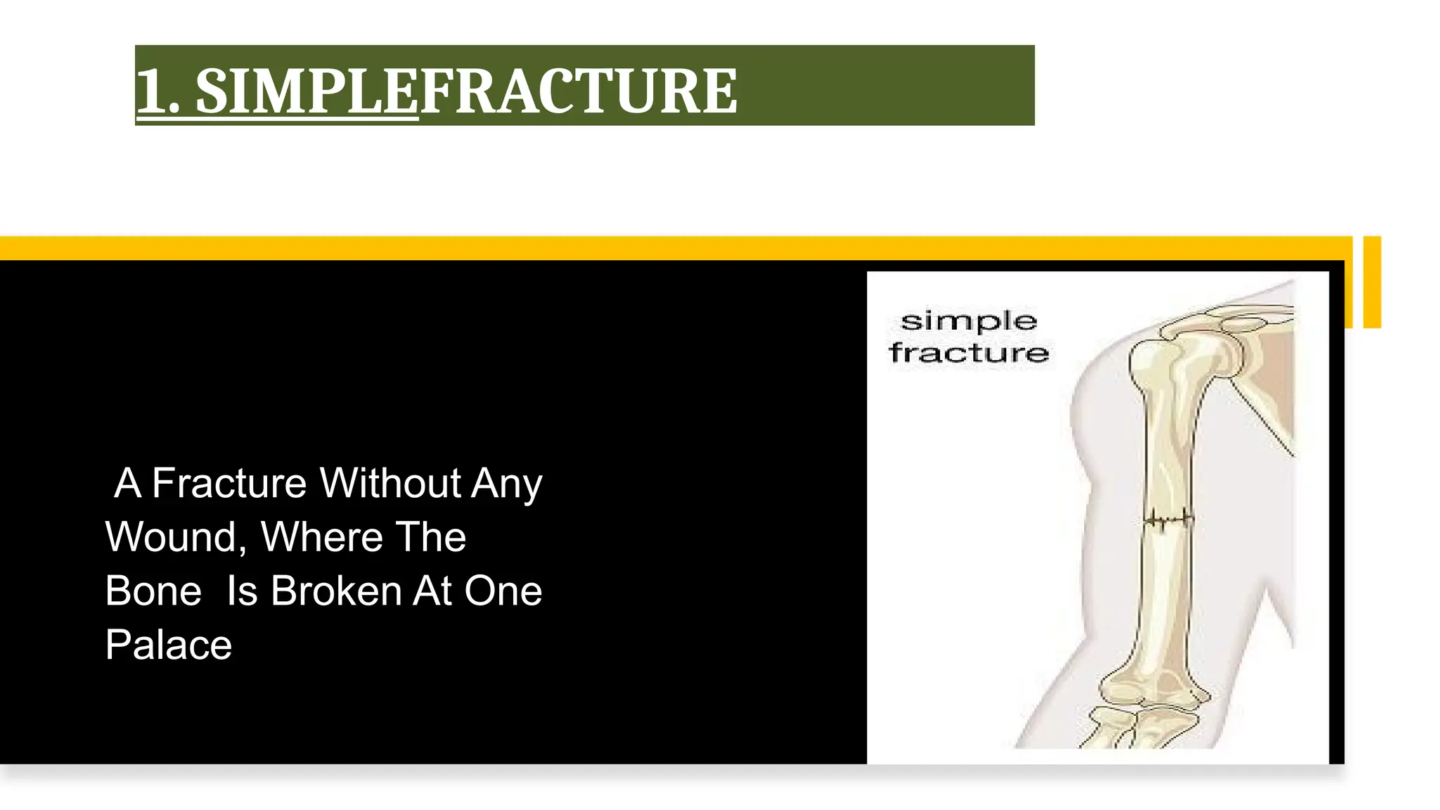 1. SIMPLEFRACTURE
A Fracture Without Any
Wound, Where The
Bone Is Broken At One
Palace
 