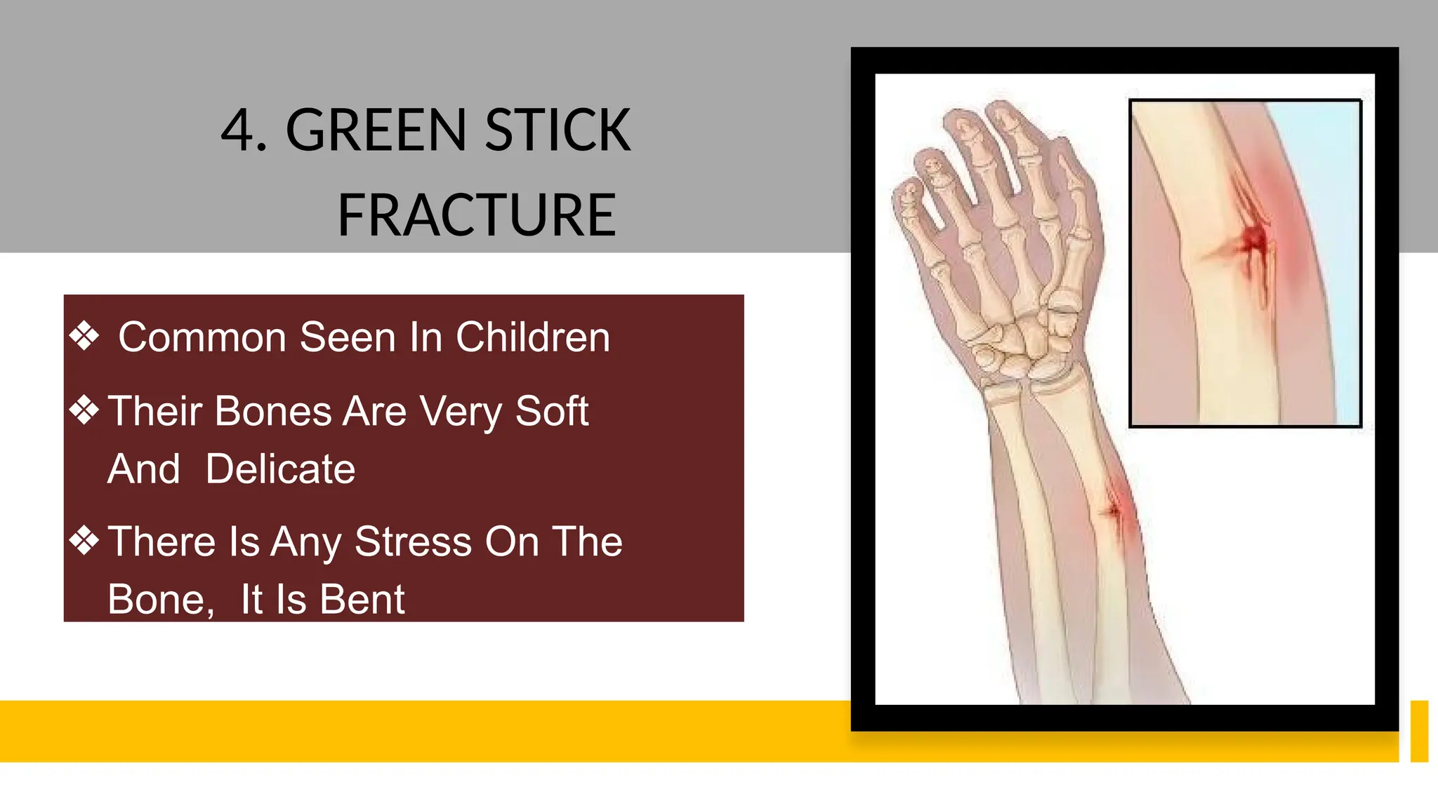 4. GREEN STICK
FRACTURE
❖ Common Seen In Children
❖Their Bones Are Very Soft
And Delicate
❖There Is Any Stress On The
Bone, It Is Bent
 