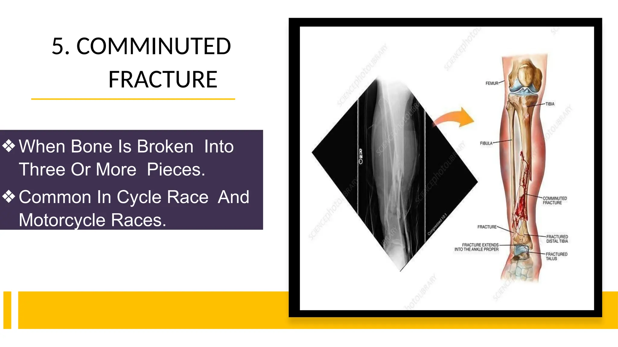 5. COMMINUTED
FRACTURE
❖When Bone Is Broken Into
Three Or More Pieces.
❖Common In Cycle Race And
Motorcycle Races.
 