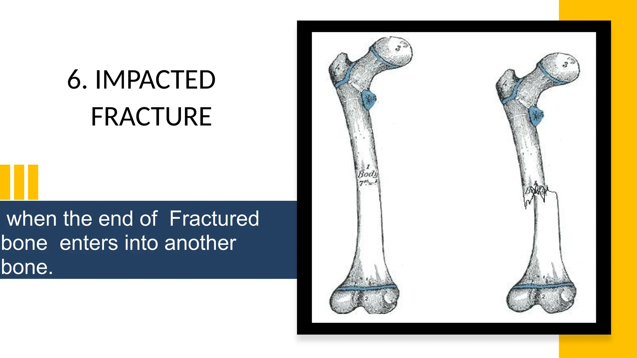 when the end of Fractured
bone enters into another
bone.
6. IMPACTED
FRACTURE
 