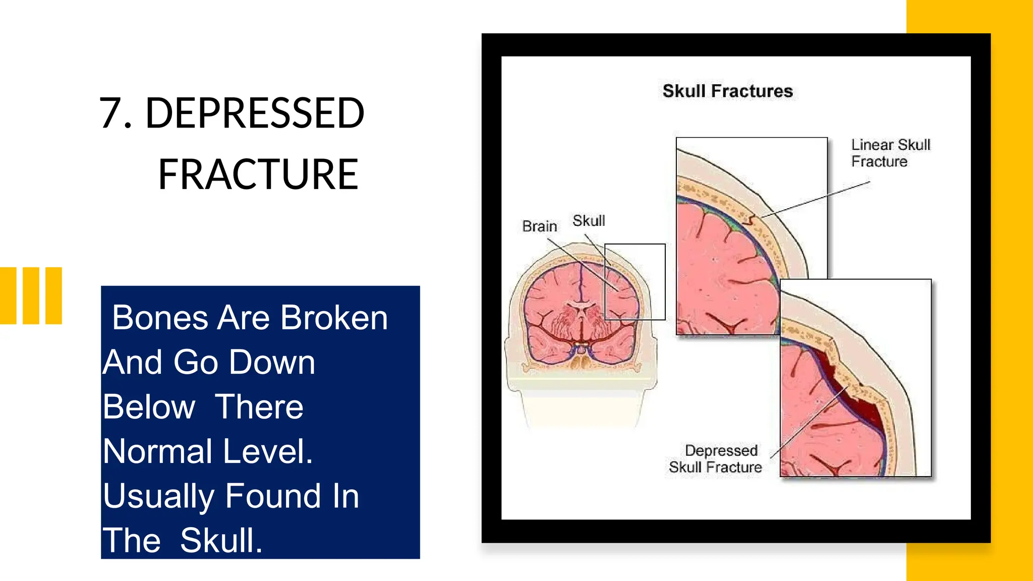 7. DEPRESSED
FRACTURE
Bones Are Broken
And Go Down
Below There
Normal Level.
Usually Found In
The Skull.
 