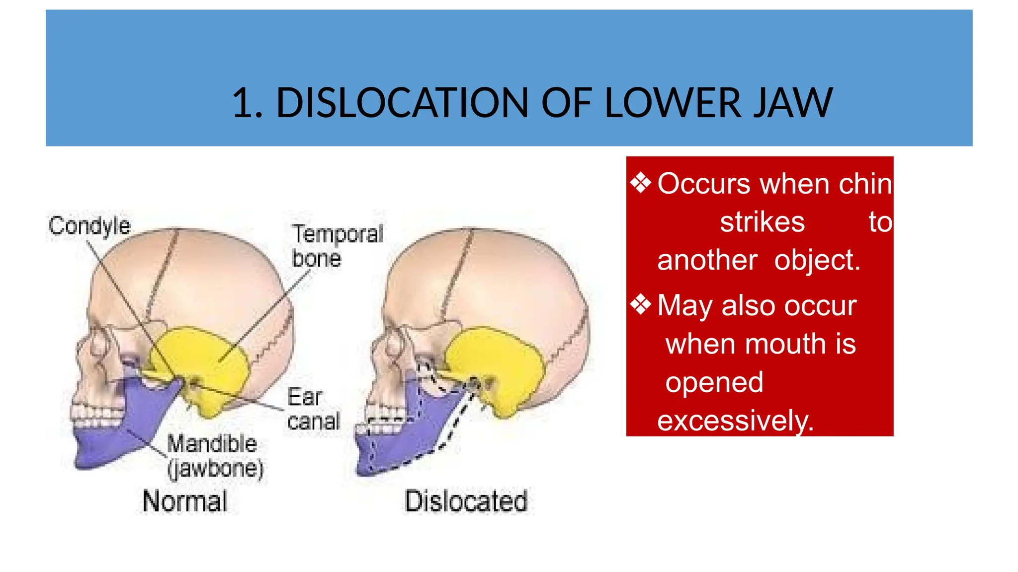 1. DISLOCATION OF LOWER JAW
❖Occurs when chin
strikes to
another object.
❖May also occur
when mouth is
opened
excessively.
 