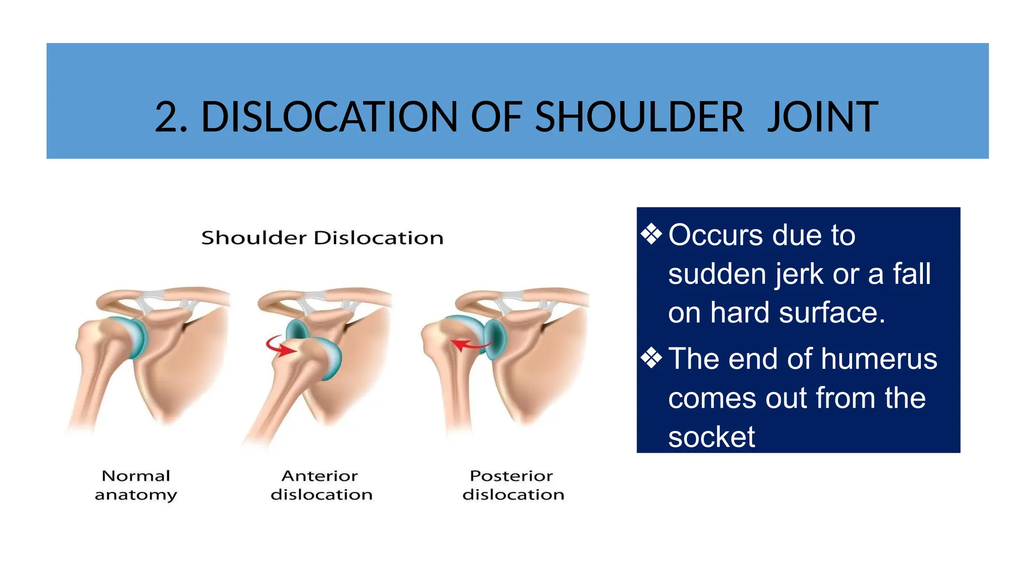2. DISLOCATION OF SHOULDER JOINT
❖Occurs due to
sudden jerk or a fall
on hard surface.
❖The end of humerus
comes out from the
socket
 