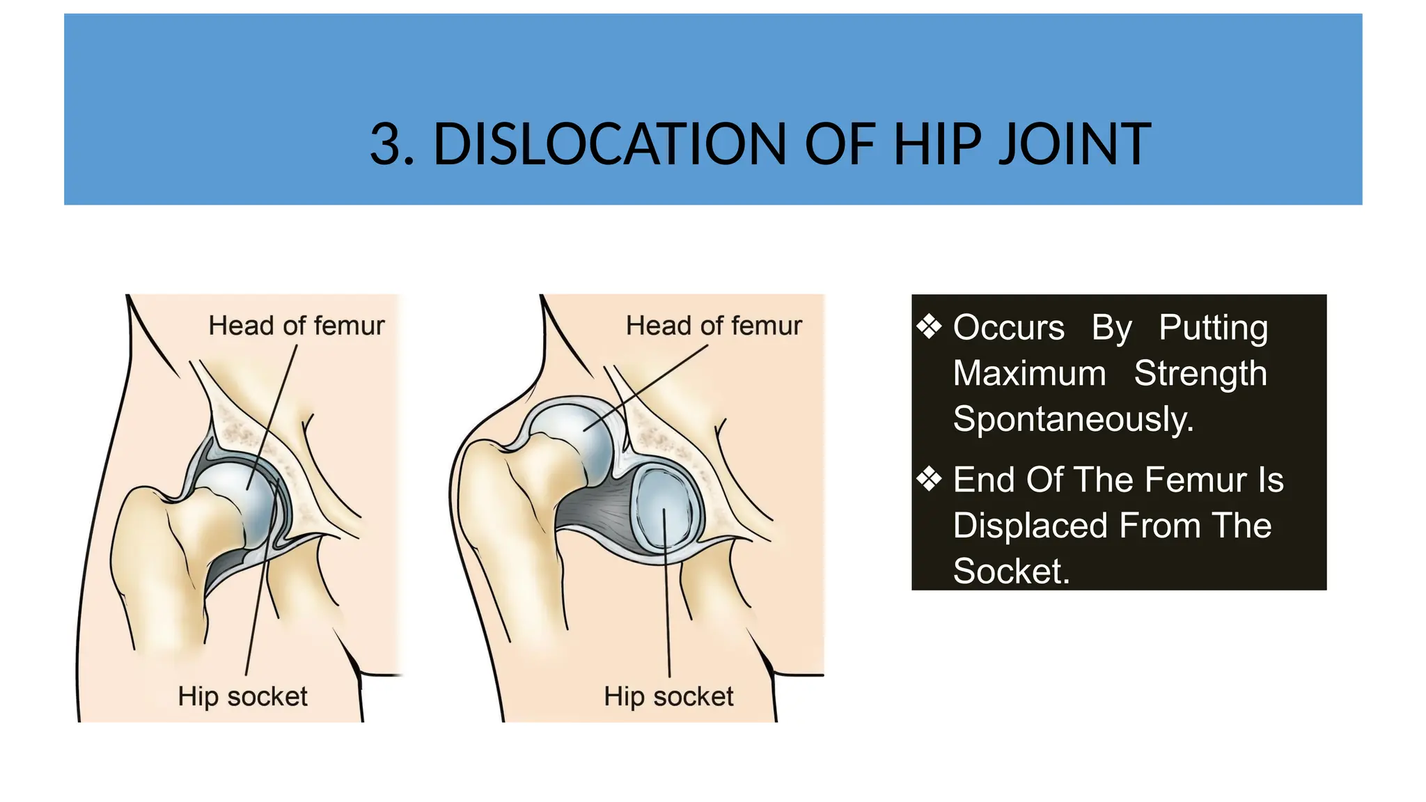 3. DISLOCATION OF HIP JOINT
❖ Occurs By Putting
Maximum Strength
Spontaneously.
❖ End Of The Femur Is
Displaced From The
Socket.
 