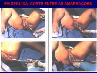 EM SEGUIDA, CORTE ENTRE AS AMARRAÇÕES   