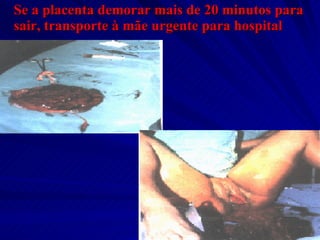 Se a placenta demorar mais de 20 minutos para sair, transporte à mãe urgente para hospital   