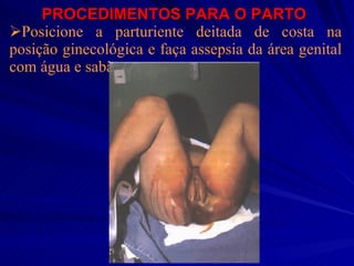 PROCEDIMENTOS PARA O PARTO   Posicione a parturiente deitada de costa na posição ginecológica e faça assepsia da área genital com água e sabão   