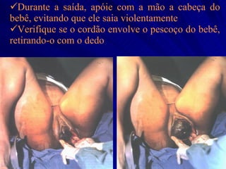 Durante a saída, apóie com a mão a cabeça do bebê, evitando que ele saia violentamente Verifique se o cordão envolve o pescoço do bebê, retirando-o com o dedo 