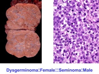 Dysgerminoma:Female::Seminoma:Male 
 
